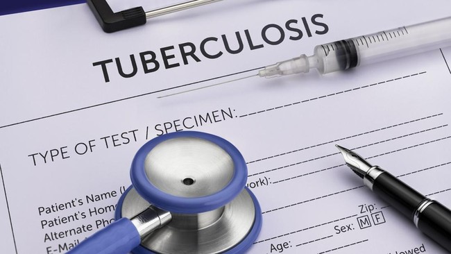 Pemkot Malang Terus Sosialisasikan Soal Tuberculosis